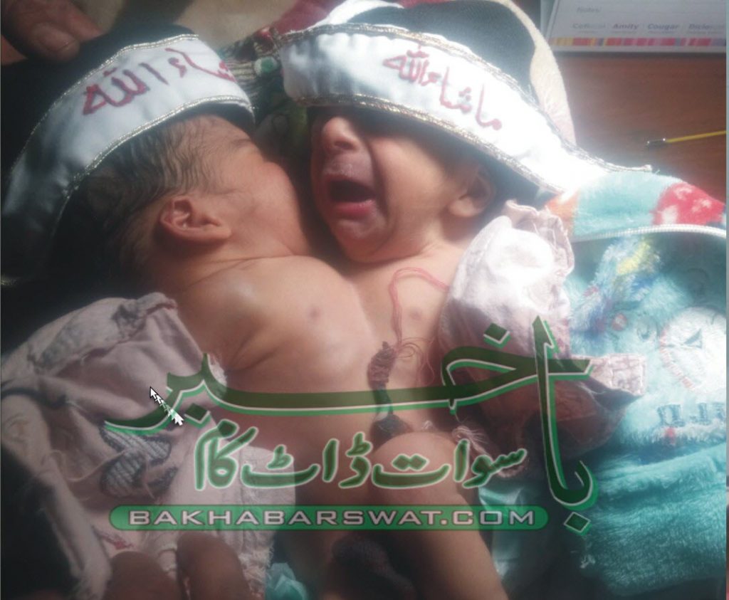 جڑواں بچوں کی پیدائش جن کے دھڑ جڑے ہوئے ہیں