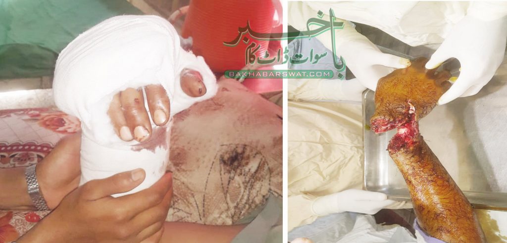 سوات، پہلی بار مکمل کٹے ہوئے ہاتھ کا کامیاب آپریشن کیا گیا