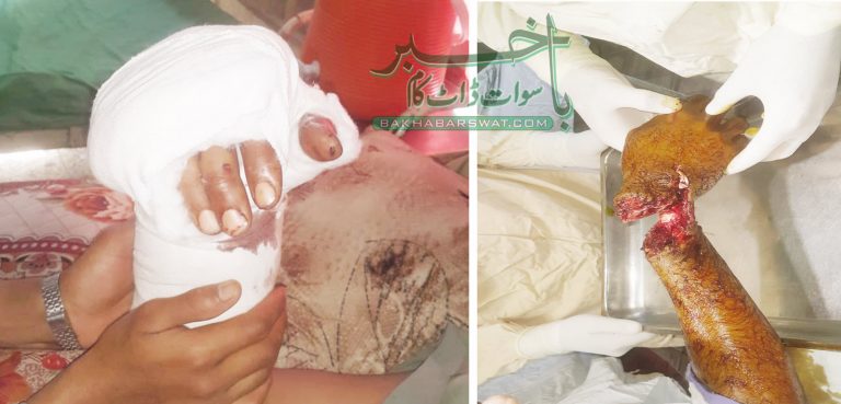 سوات، پہلی بار مکمل کٹے ہوئے ہاتھ کا کامیاب آپریشن کیا گیا
