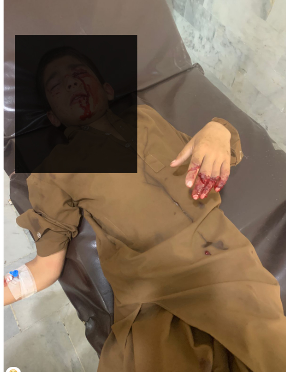 کبل اسوگے، پرانا دستی بم پھٹنے سے دو بچے زخمی